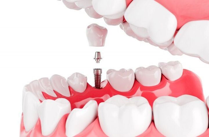 Dental Implants Guide: Implant Types, Placement Process, Materials and Care Considerations
